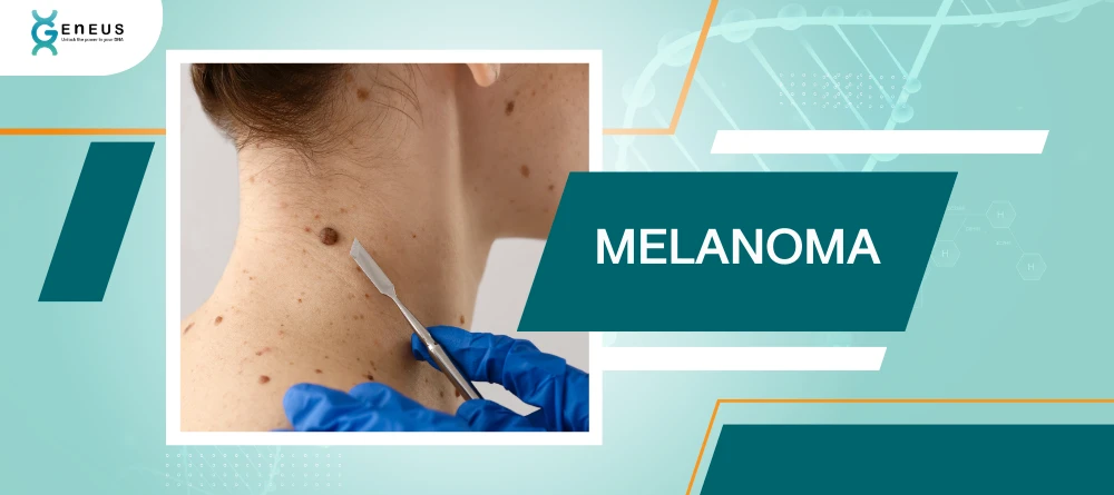 Melanoma